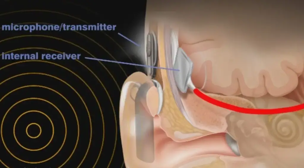 What Is Ionic Ear?